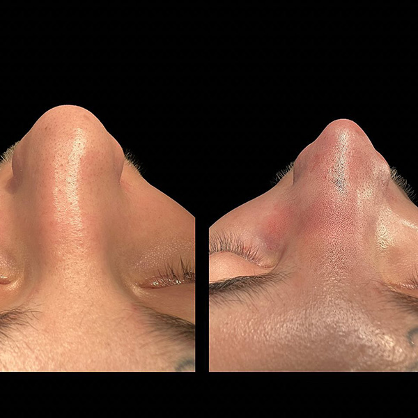 dr-guilherme-sampaio-resultados-antes-e-depois-11