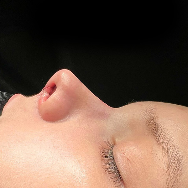 dr-guilherme-sampaio-resultados-antes-e-depois-13