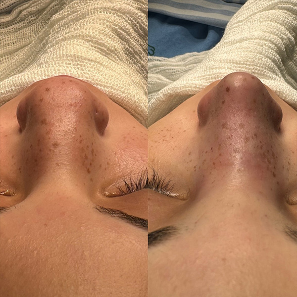 dr-guilherme-sampaio-resultados-antes-e-depois-4