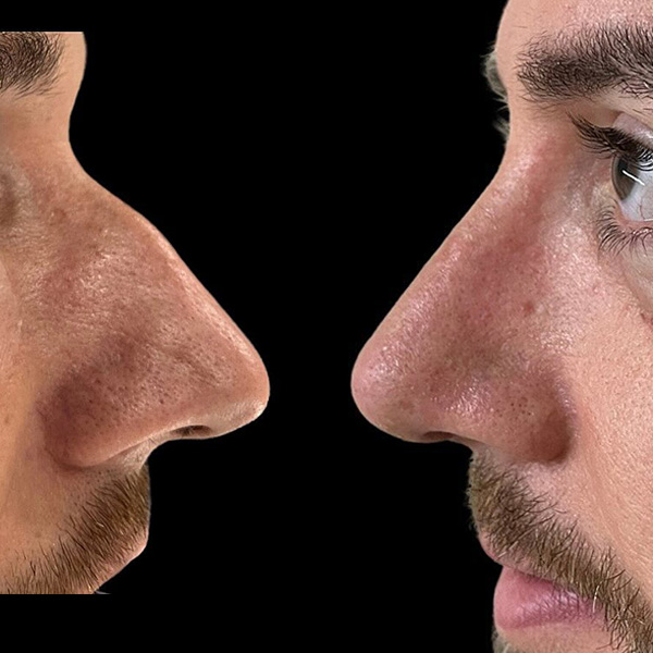 dr-guilherme-sampaio-resultados-antes-e-depois-5