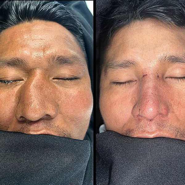 dr-guilherme-sampaio-resultados-antes-e-depois-6
