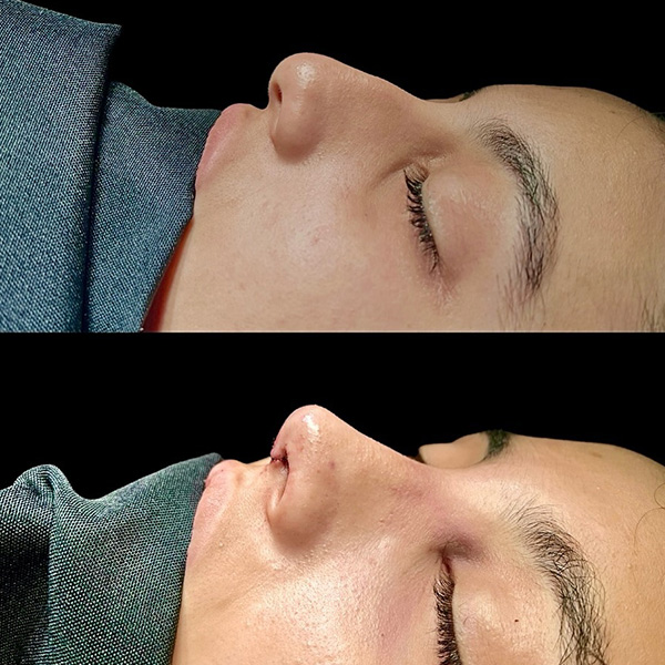 dr-guilherme-sampaio-resultados-antes-e-depois-7
