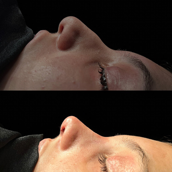 dr-guilherme-sampaio-resultados-antes-e-depois-8