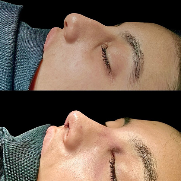 dr-guilherme-sampaio-resultados-antes-e-depois-9
